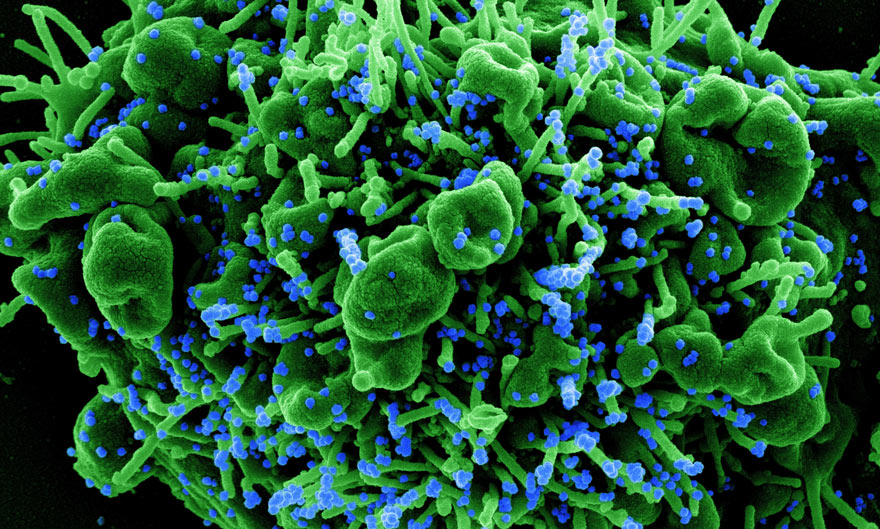 Colorized scanning electron micrograph of an apoptotic cell (green) infected with SARS-COV-2 virus particles