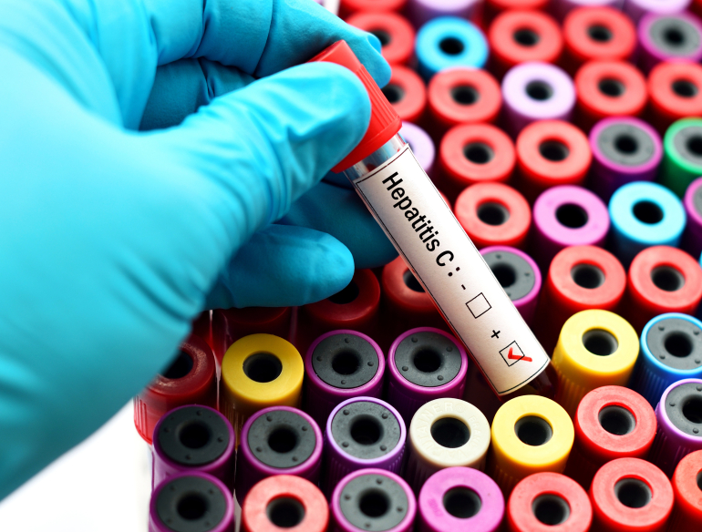 Hepatitis C blood test stock image