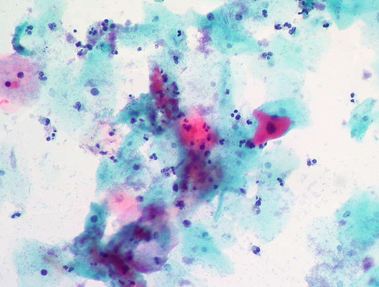 Photomicrograph of immunostained pap smear, which tested positive for high risk HPV. Credit: Ed Uthman/Flickr (CC BY-SA 2.0)