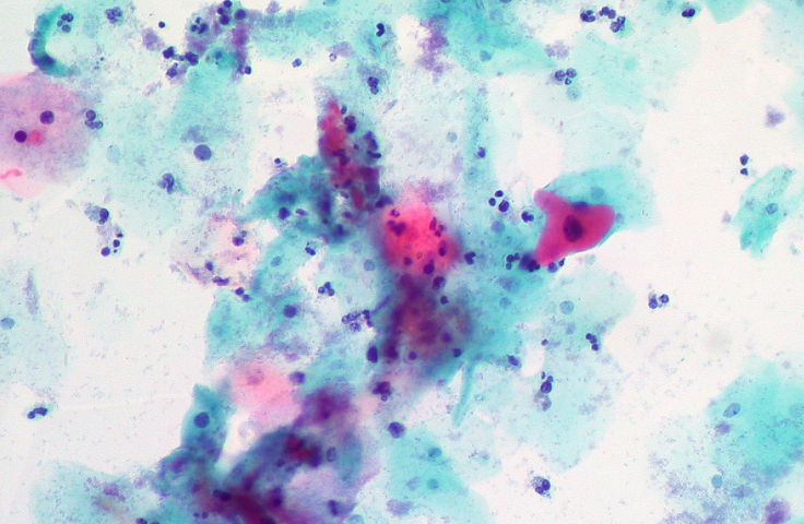 Photomicrograph of immunostained pap smear, which tested positive for high risk HPV. Credit: Ed Uthman/Flickr (CC BY-SA 2.0)